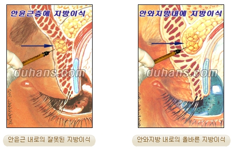 [Duhan Plastic Surgery Micro Fat Grafting] - [Upper Eyelids] image 3