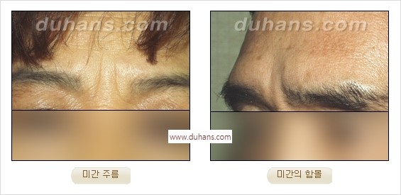 [두한성형외과 경쟁력 주름성형] - [간단하면서 자연스러운 주름제거 방법] 관련 이미지 4