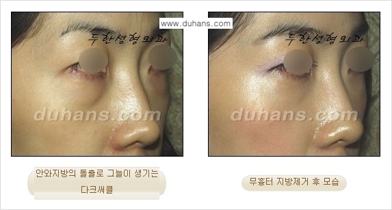 [두한성형외과 젊은 눈매 안검성형] - [눈밑 지방제거의 수술 전후 안내 ①] 관련 이미지 7