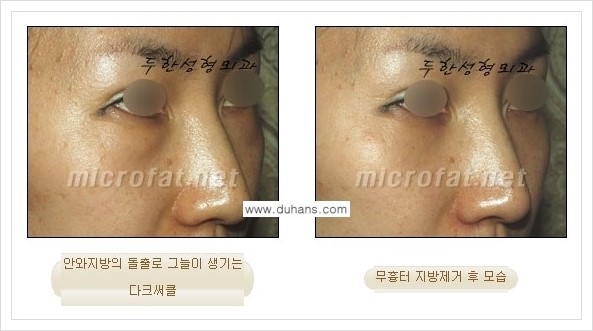 [두한성형외과 경쟁력 눈밑성형] - [눈밑지방제거, 눈위지방제거 안내 1.] 관련 이미지 18