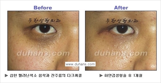 [두한성형외과의 상큼하고 환한 젊은 눈매완성] - [하안검 성형술 ②] 관련 이미지 9