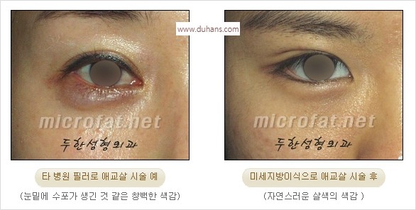 [두한성형외과 경쟁력 눈밑성형] - [눈밑애교살 시술을 위한 미세지방이식] 관련 이미지 15