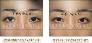 [두한성형외과 쌍커풀수술] - [쌍꺼풀지방이식] 관련 이미지 23