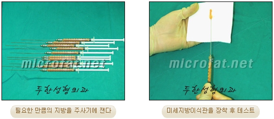 [두한성형외과 얼굴지방이식] - [측두부, 관자놀이] 관련 이미지 5