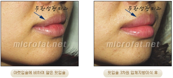 [Duhan Plastic Surgery Lip Surgery] - [Lip Correction Fat Grafting] image 16