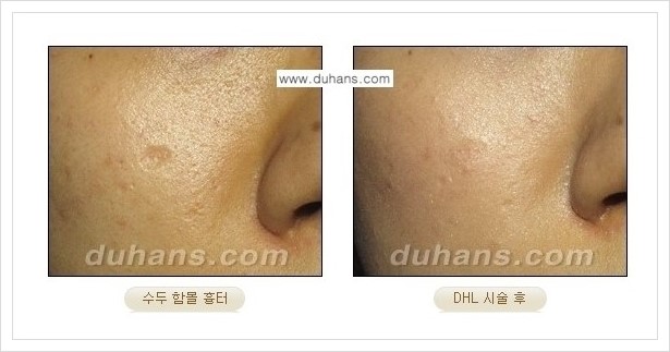 ​[두한성형외과 경쟁력 흉터성형] - [함몰흉터의 DHC 시술] 관련 이미지 4