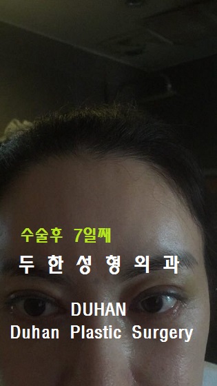 [두한성형외과 쌍커풀 재수술] - [재수술 실패의 원인, 나에게 맞는 쌍커풀] 관련 이미지 33