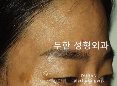 [Duhan Plastic Surgery Forehead Surgery] - [Forehead Fat Grafting for Forehead Surgery] image 15