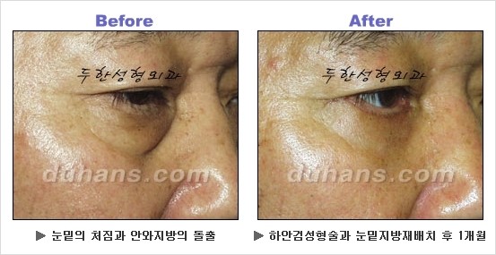[두한성형외과 경쟁력 동안성형 리더] - ​[미간주름, 이마주름, 안검성형, 이마거상술, 눈썹거상술] 관련 이미지 76
