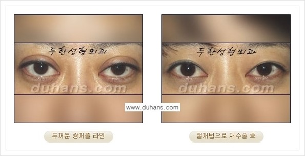 [두한성형외과 경쟁력 쌍꺼풀 재수술, 극한 재수술] - [두꺼운 쌍꺼풀 라인의 교정 방법 안내] 관련 이미지 5