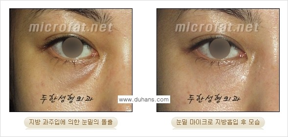 ​[두한성형외과 가을엔 지방흡입을] - [볼살, 눈밑, 턱선 초음파 미세지방흡입] 관련 이미지 5