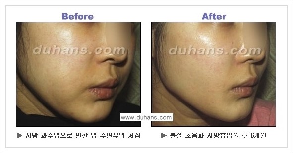 [두한성형외과 경쟁력 지방흡입] - [볼살지방흡입 안내] 관련 이미지 3