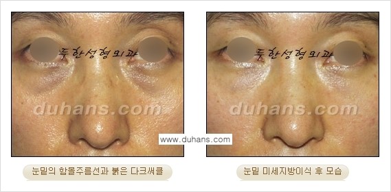 [두한성형외과 경쟁력 미세지방이식] - [다크써클 & 눈밑주름 미세지방이식 3.] 관련 이미지 10