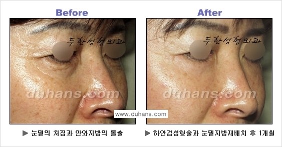 [두한성형외과의 상큼하고 환한 젊은 눈매완성] - [하안검 성형술 ①] 관련 이미지 26