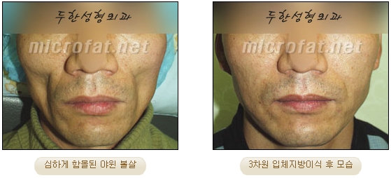 얼굴지방이식 두한성형외과 - 볼지방이식 관련 이미지 33