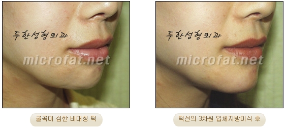 [두한성형외과 미세지방이식] - [무턱교정 안내] 관련 이미지 22