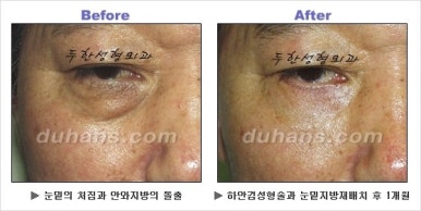 [두한성형외과 안검성형] - [상안검, 하안검] 관련 이미지 28