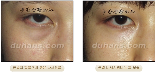 [두한성형외과 지방이식] - [눈밑 다크써클] 관련 이미지 28