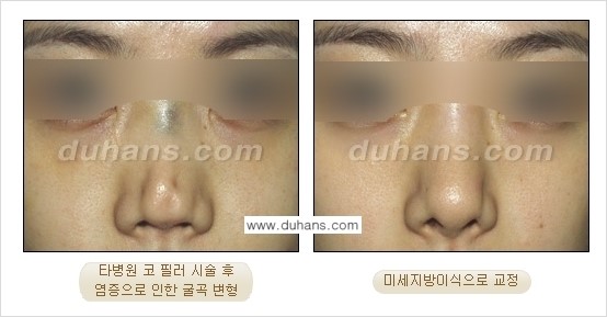 [두한성형외과 주름교정술] - [필러에 대하여 알아야 할 지식] 관련 이미지 4