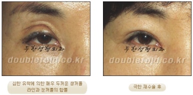 쌍꺼풀수술 두한성형외과 - 쌍커풀재수술의 문제점 관련 이미지 17