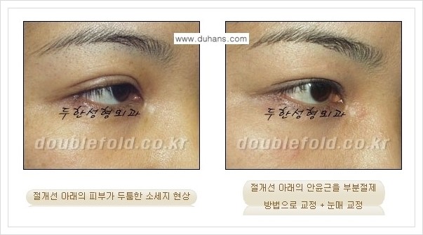 [두한성형외과 경쟁력 쌍꺼풀  재수술, 극한 재수술] - [절개선 아래가 두툼한(소세지 쌍꺼풀) 현상 교정 안내] 관련 이미지 4