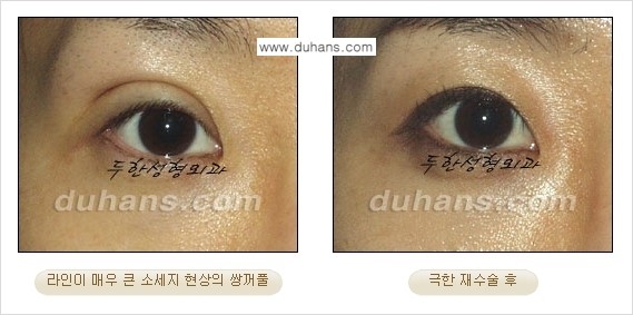 [두한성형외과 경쟁력 눈성형] - [두꺼운 라인을 교정하는 극한 눈 재수술 2.] 관련 이미지 6