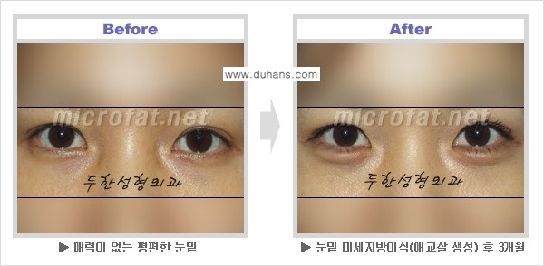 [두한성형외과 NO 1. "Col-fat 지방이식"] - [지방이식의 지속효과, 오해와 진실, 부작용] 관련 이미지 8