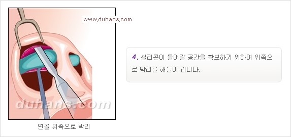 [두한성형외과 경쟁력 코성형] - [코성형을 위한 알로덤(슈어덤) 수술, 실리콘 수술 안내] 관련 이미지 22