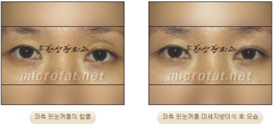 [Doohan Plastic Surgery Autologous Fat Grafting] - [Sunken Eye Fat Grafting] image 23