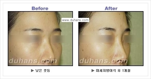 [두한성형외과 경쟁력 코성형] - [코높힘 미세지방이식 정보 안내] 관련 이미지 4