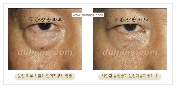 [두한성형외과 경쟁력 눈성형] - [젊은 눈매로의 복원 안검성형] 관련 이미지 26