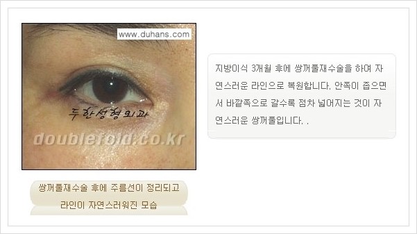 [두한성형외과 경쟁력 쌍꺼풀 재수술, 극한 재수술] - [쌍꺼풀 재수술의 과정 안내 2.] 관련 이미지 3