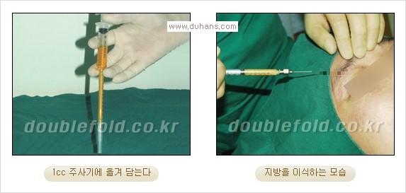 [두한성형외과 경쟁력 쌍꺼풀 재수술 리더] - [풀린 쌍꺼풀, 풀려버린 쌍꺼풀 재수술 방법 안내] 관련 이미지 3
