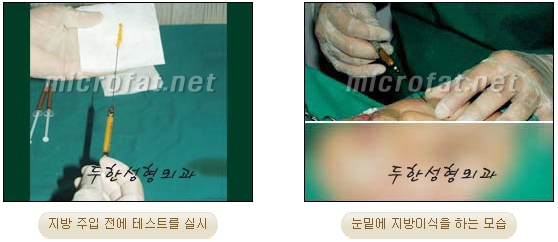 두한성형외과 눈밑성형 - 애교필러 후 눈밑재수술 관련 이미지 13
