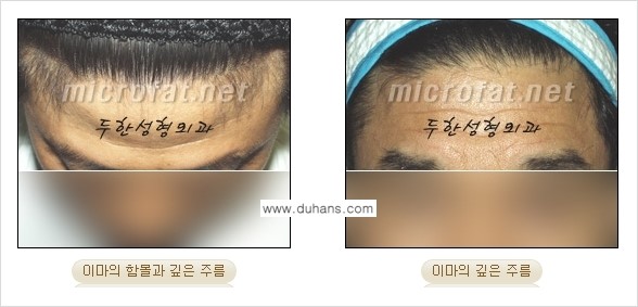 [두한성형외과의 경쟁력 미세지방이식] - [이마 미세지방이식 안내 ①] 관련 이미지 5