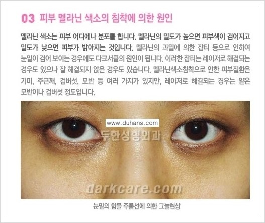 [두한성형외과 경쟁력 다크써클 교정] - [다크써클의 원인 안내] 관련 이미지 6