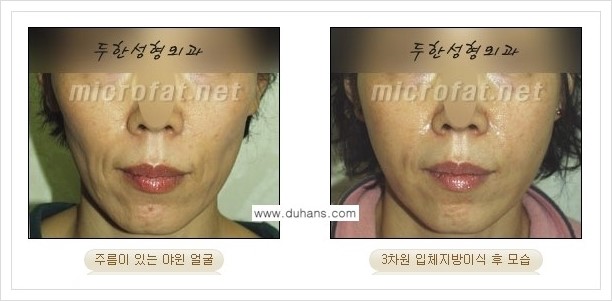 [두한성형외과 경쟁력 미세지방이식] - [볼살 지방이식 - 야윈볼살, 역삼각형의 협소한 얼굴] 관련 이미지 3