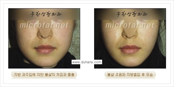 [두한성형외과 겨울엔 지방흡입을] - [볼살, 눈밑, 턱선의 초음파 미세지방흡입 1.] 관련 이미지 9