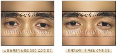 [두한성형외과 쌍커풀수술] - [쌍꺼풀지방이식] 관련 이미지 35