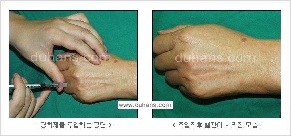 [두한성형외과 정맥 혈관 확장으로 인한 피부개선] - [손, 팔 혈관 확장] 관련 이미지 9