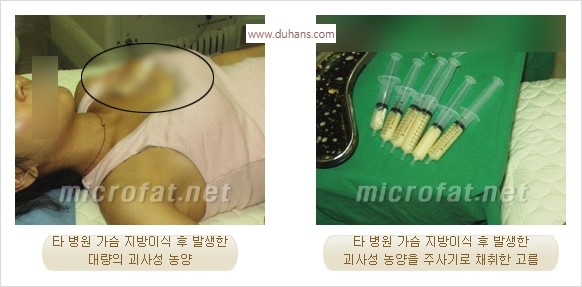 [두한성형외과 경쟁력 미세지방이식] - [타 병원의 지방이식 부작용 교정 - 정교한 마이크로 지방이식, 흡입 안내] 관련 이미지 11