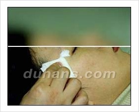 Duhan Plastic Surgery Wrinkle Improvement - Wrinkle Fillers, Juvederm image 8