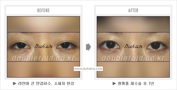 [두한성형외과 경쟁력 쌍꺼풀 재수술, 극한 눈재수술] - [두툼한 소세지 쌍꺼풀 라인 교정] 관련 이미지 11