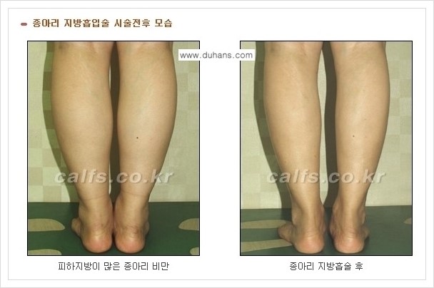 [두한성형외과 경쟁력 멀티종아리성형] - [정교한 미세흡입관 종아리 지방흡입술] 관련 이미지 7