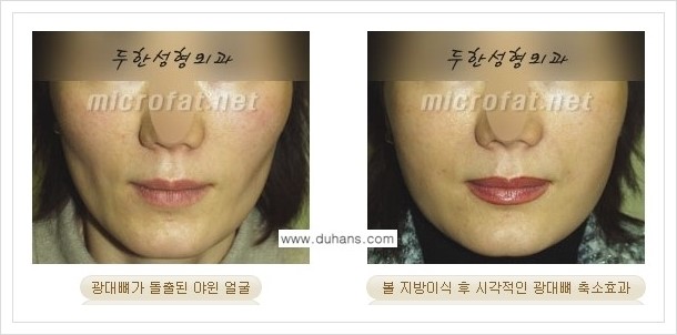 [두한성형외과 경쟁력 안면윤곽 성형] - [광대뼈 돌출, 사각턱, 야윈볼살, 역삼각형의 협소한 얼굴, 측면 볼살의 함몰선, 안면비대칭 미세지방이식] 관련 이미지 5