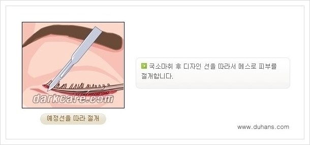 [두한성형외과 경쟁력 다크써클 치료] - [하안검 성형과 눈밑지방 재배치 안내] 관련 이미지 4