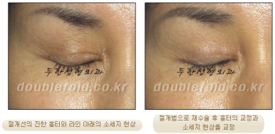 [두한성형외과 쌍커풀재수술] - [쌍수흉터] 관련 이미지 13