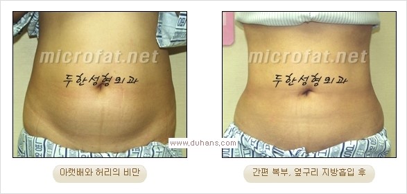 [두한성형외과 경쟁력 지방흡입] - [초음파 지방흡입과 미세흡입관을 이용한 간편지방흡입] 관련 이미지 10