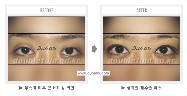 [두한성형외과 경쟁력 쌍꺼풀 재수술] - [과도한 앞트임이 되었을 경우 안내] 관련 이미지 3