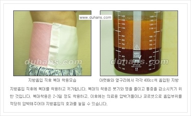 [두한성형외과 경쟁력 지방흡입] - [초음파 간편지방흡입 안내 ②] 관련 이미지 5